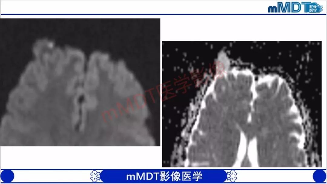 【PPT】颅骨“放射样”骨针的影像诊断