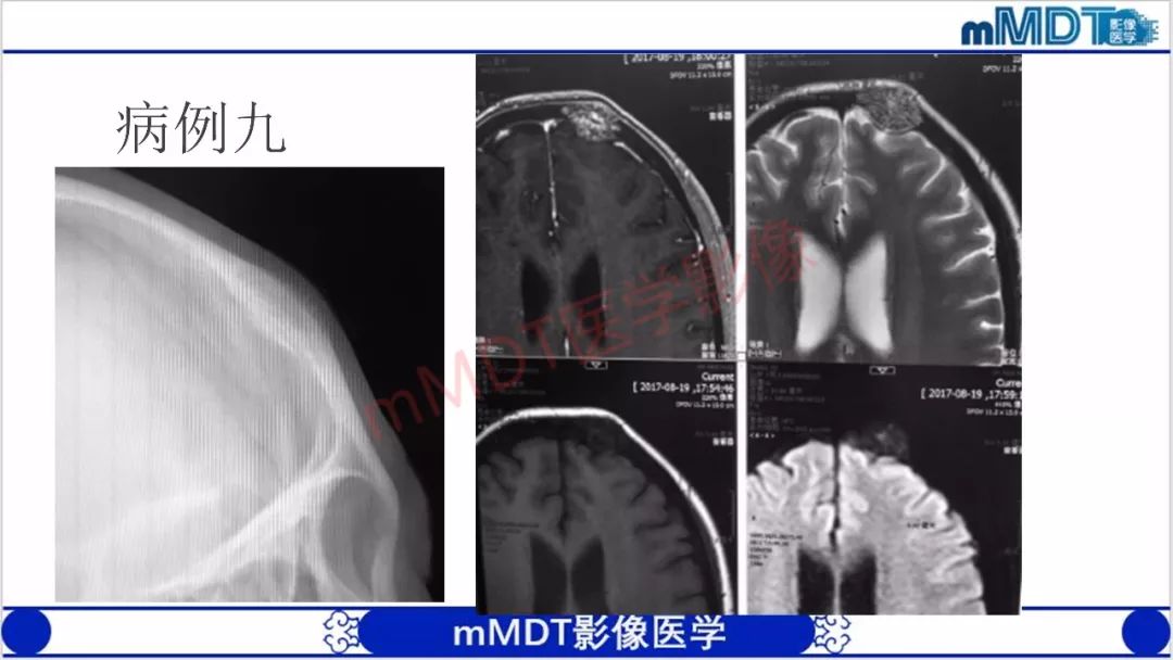 【PPT】颅骨“放射样”骨针的影像诊断