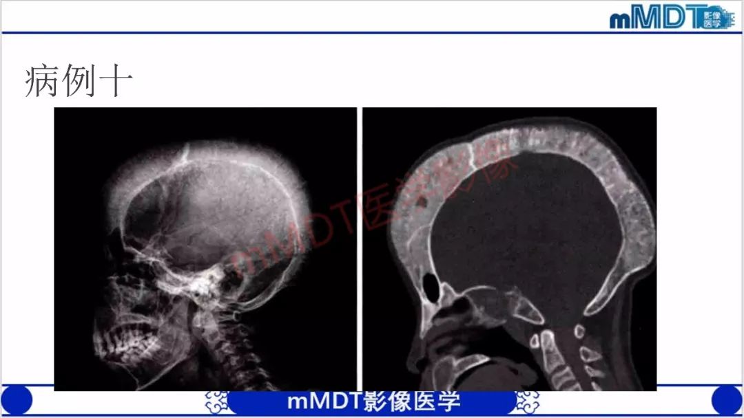 【PPT】颅骨“放射样”骨针的影像诊断