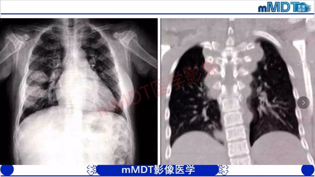 【PPT】颅骨“放射样”骨针的影像诊断