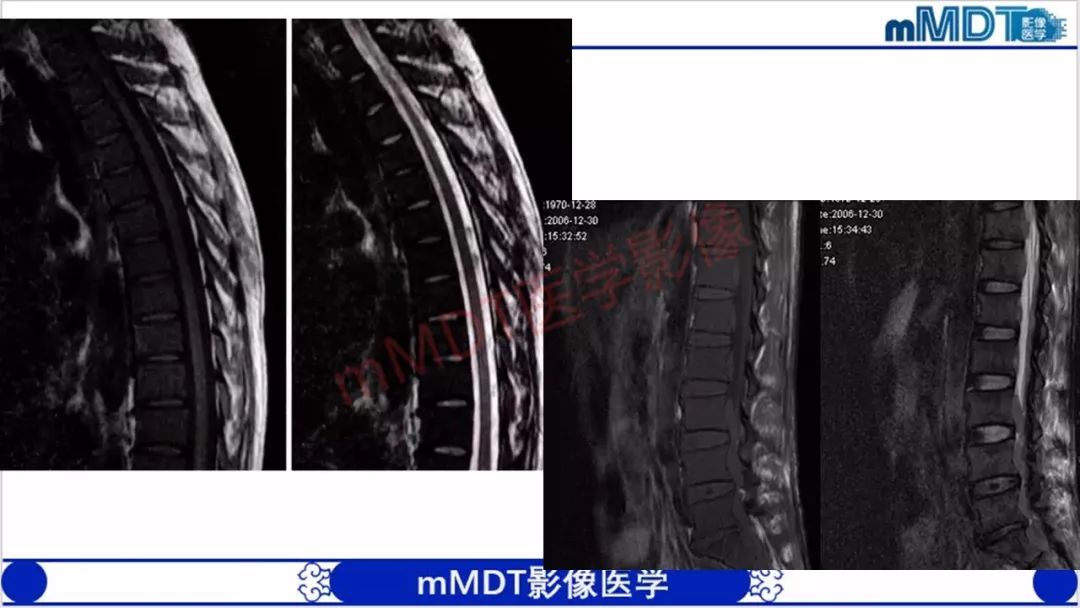 【PPT】颅骨“放射样”骨针的影像诊断