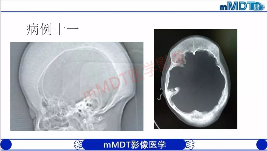 【PPT】颅骨“放射样”骨针的影像诊断