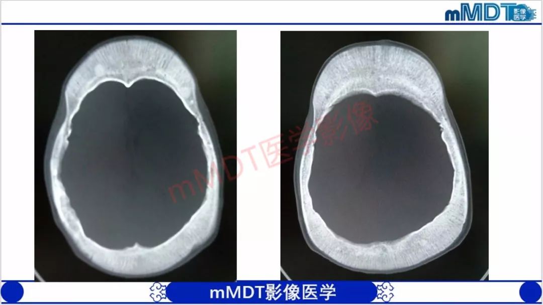 【PPT】颅骨“放射样”骨针的影像诊断