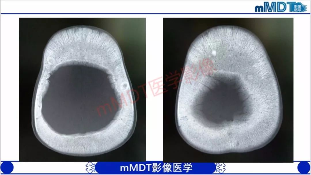 【PPT】颅骨“放射样”骨针的影像诊断