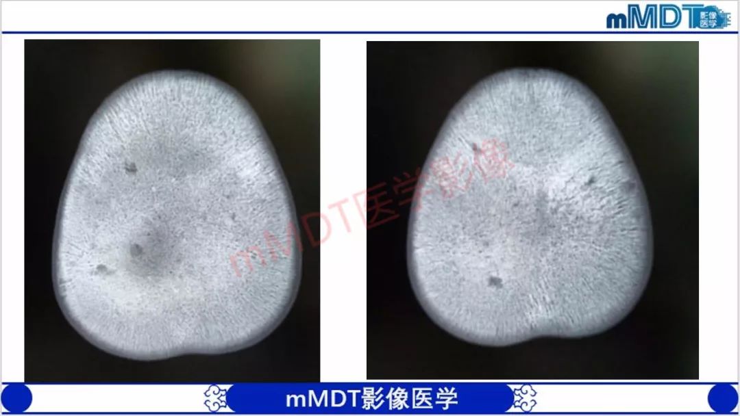 【PPT】颅骨“放射样”骨针的影像诊断