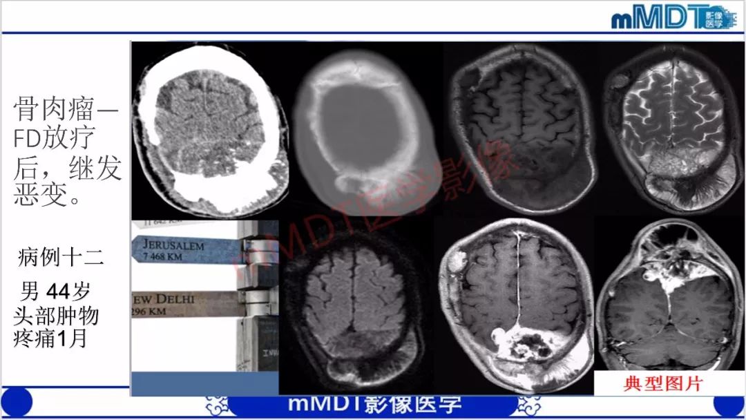 【PPT】颅骨“放射样”骨针的影像诊断
