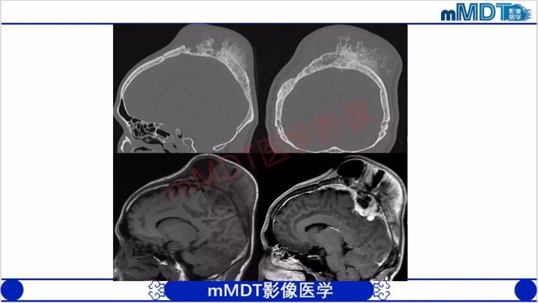 【PPT】颅骨“放射样”骨针的影像诊断