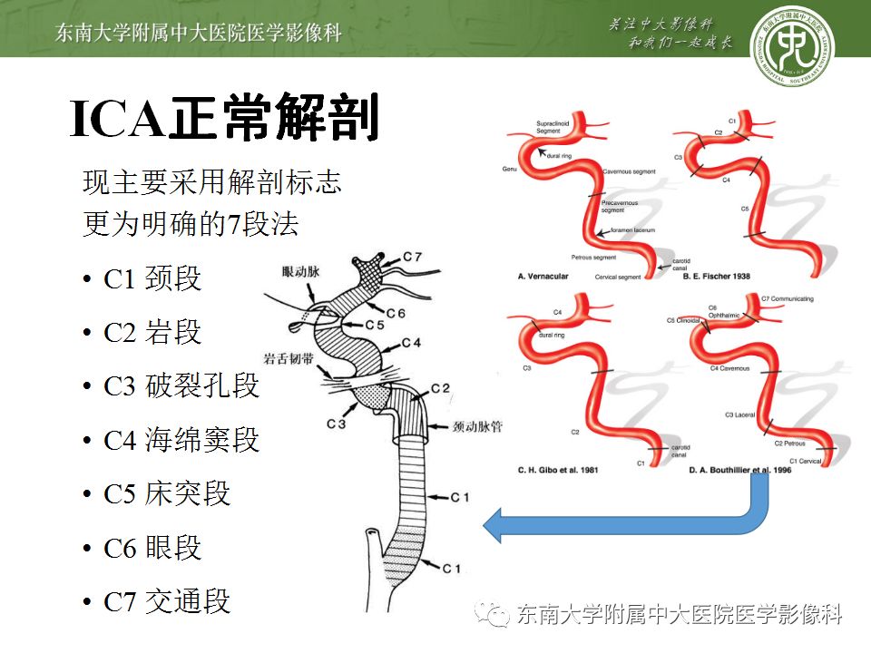 【病例】永存三叉动脉2例MRA