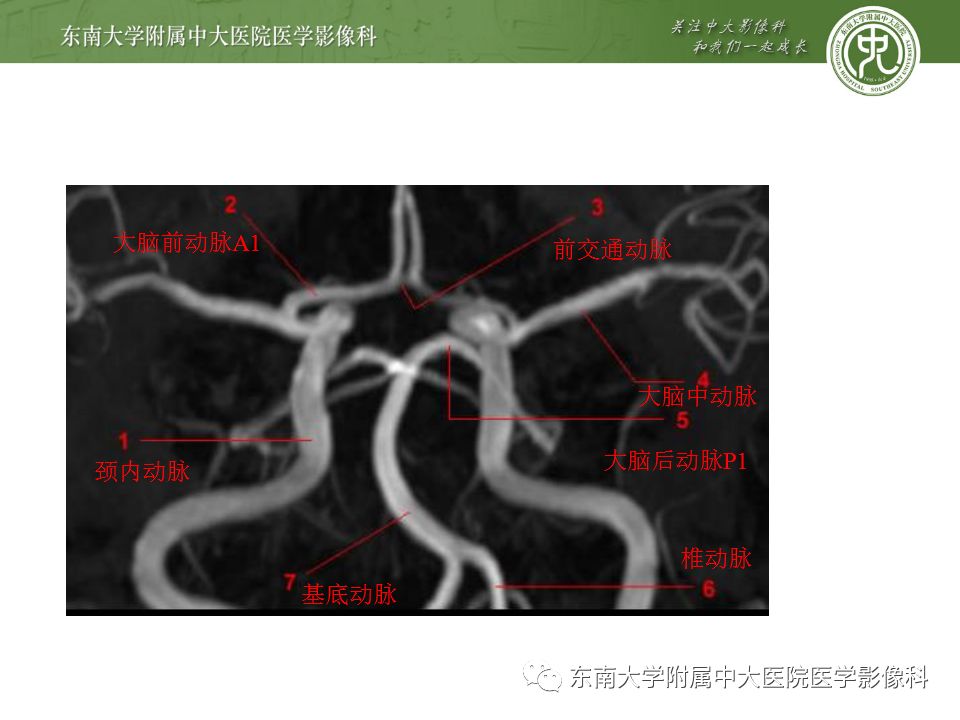 【病例】永存三叉动脉2例MRA