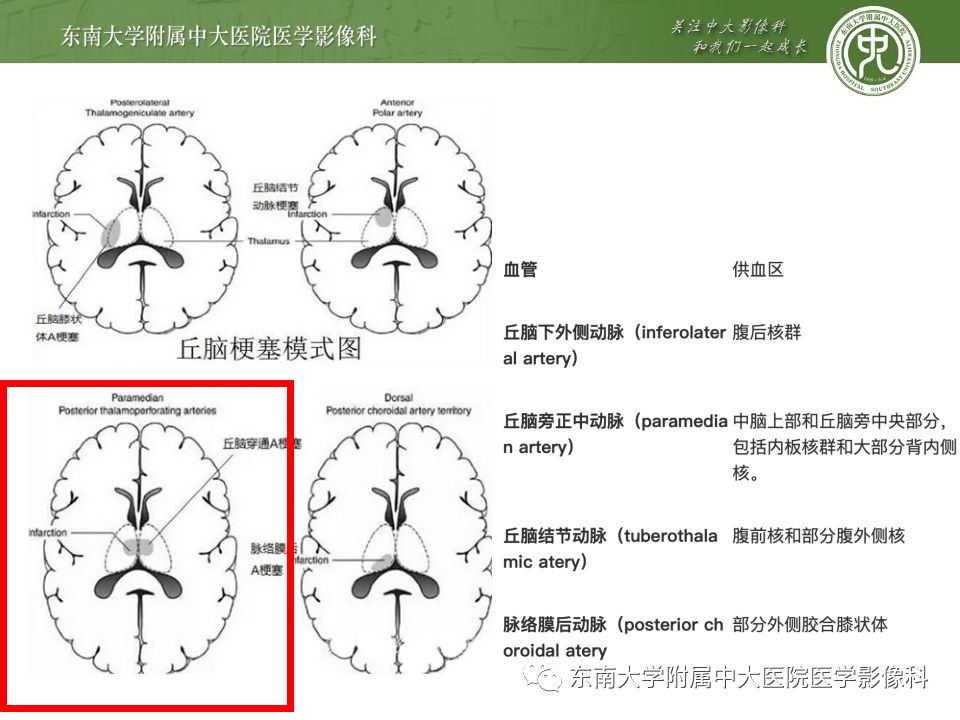 【病例】永存三叉动脉2例MRA