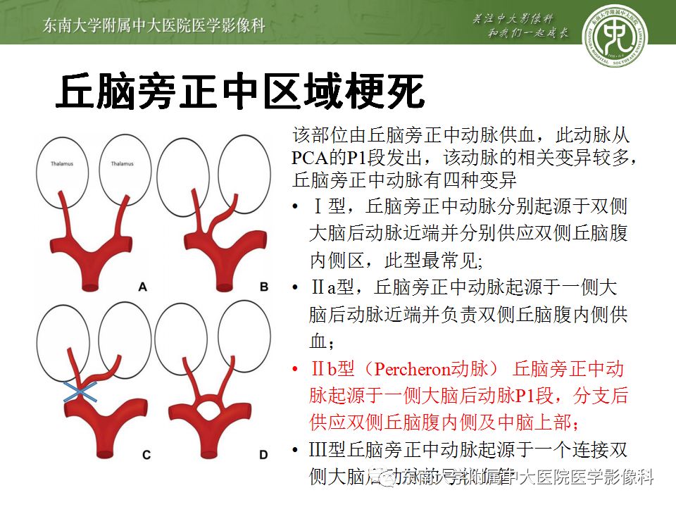 【病例】永存三叉动脉2例MRA