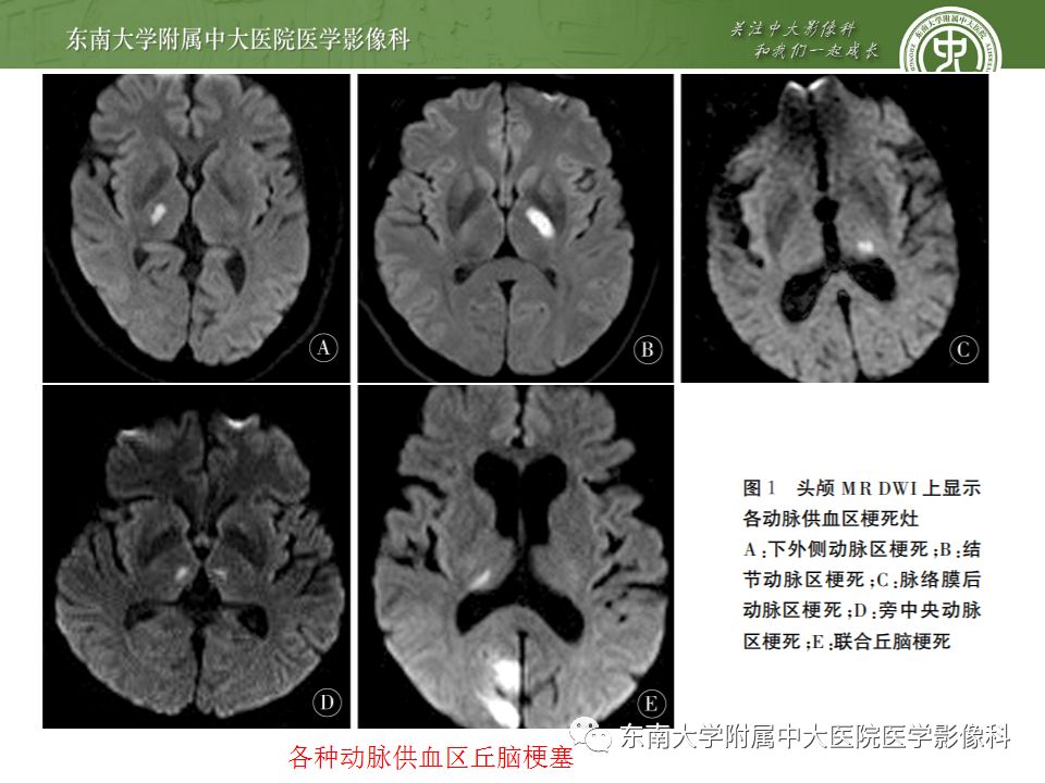 【病例】永存三叉动脉2例MRA