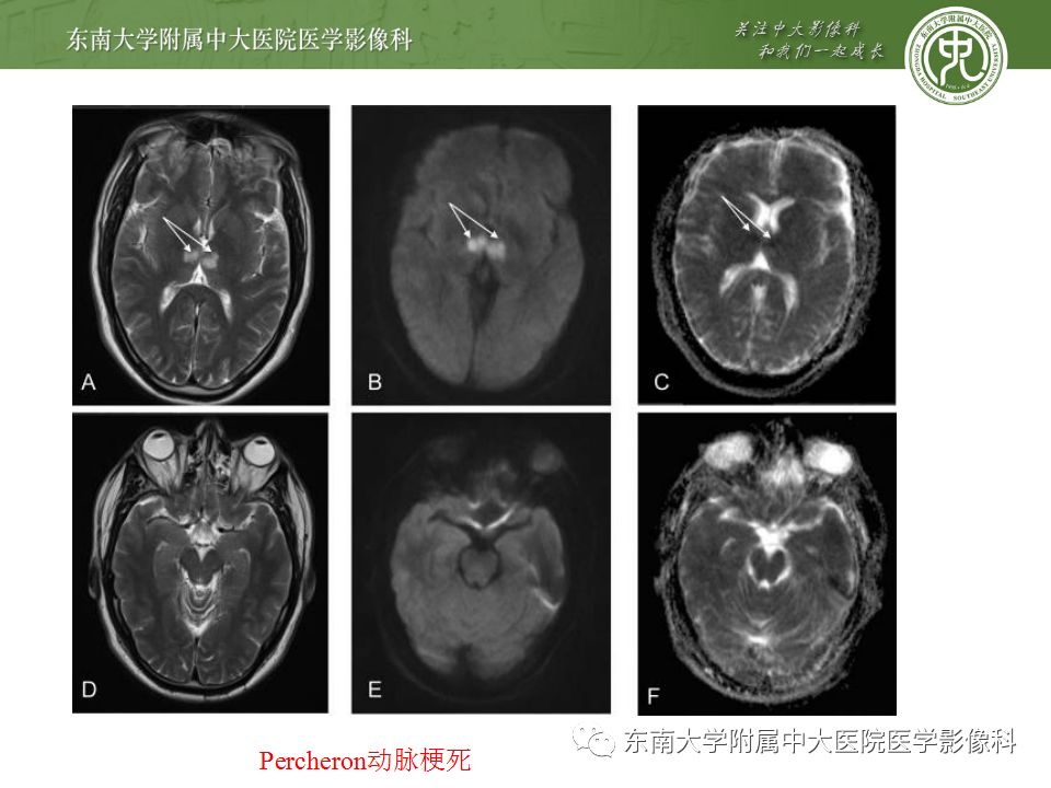【病例】永存三叉动脉2例MRA