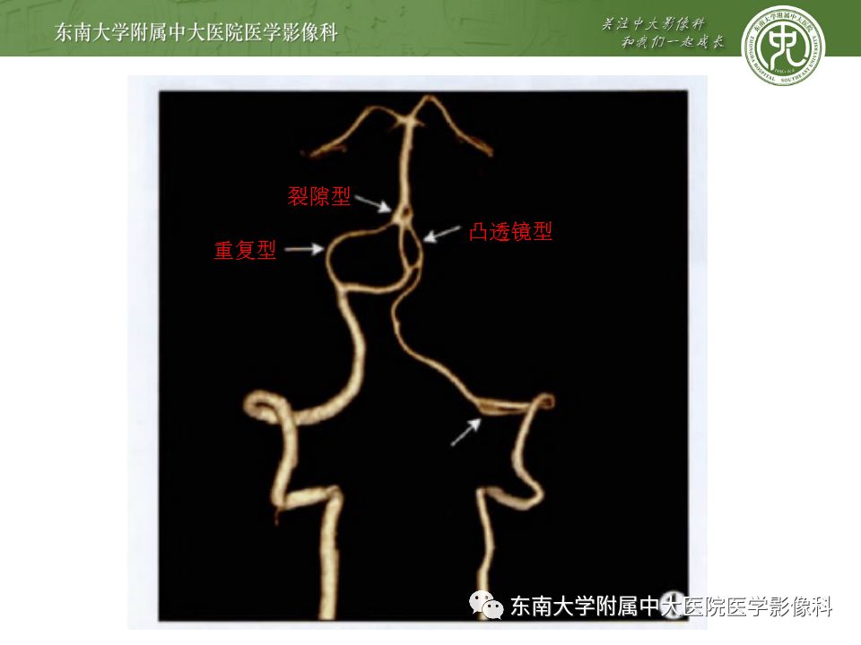 【病例】永存三叉动脉2例MRA