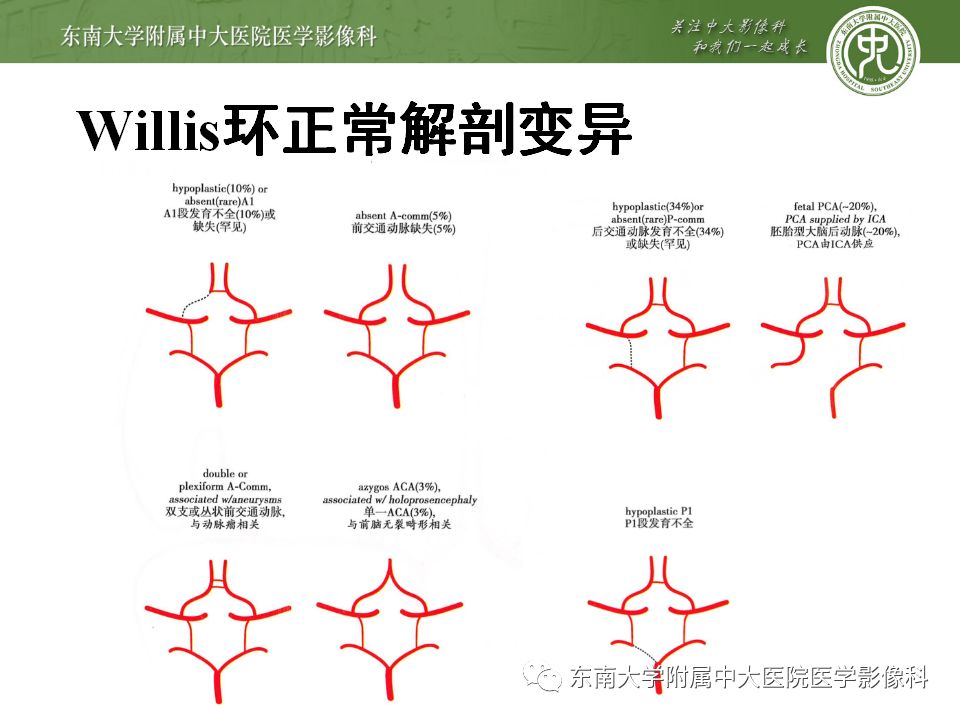 【病例】永存三叉动脉2例MRA