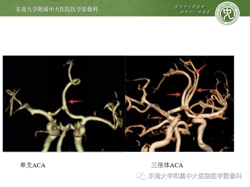 【病例】永存三叉动脉2例MRA