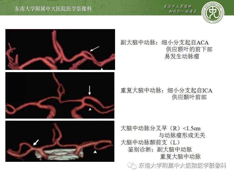 【病例】永存三叉动脉2例MRA