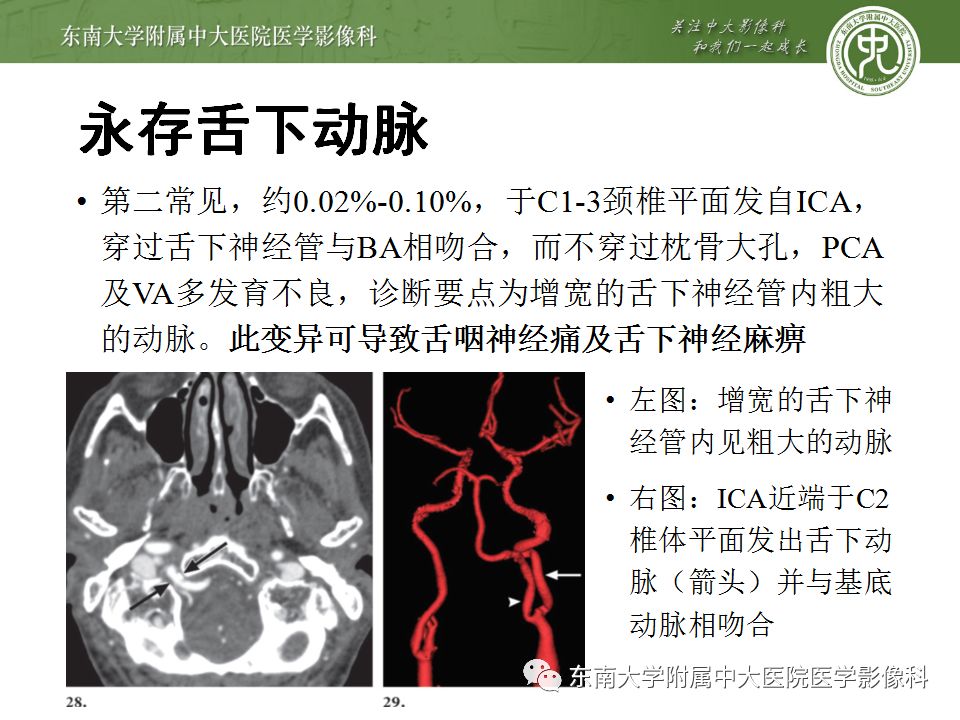 【病例】永存三叉动脉2例MRA