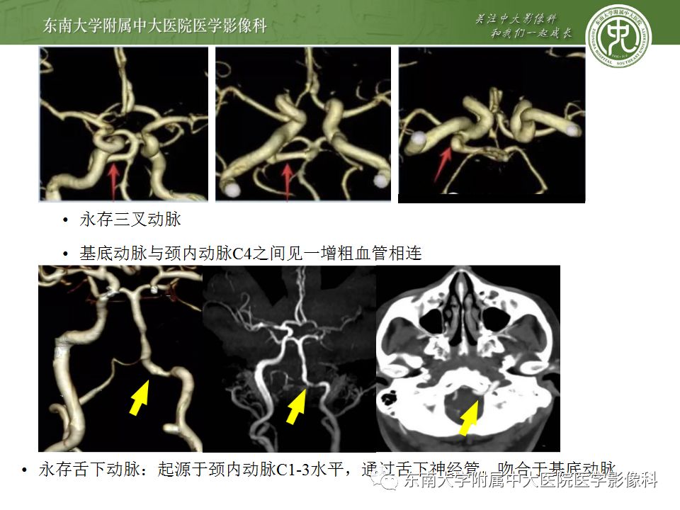 【病例】永存三叉动脉2例MRA