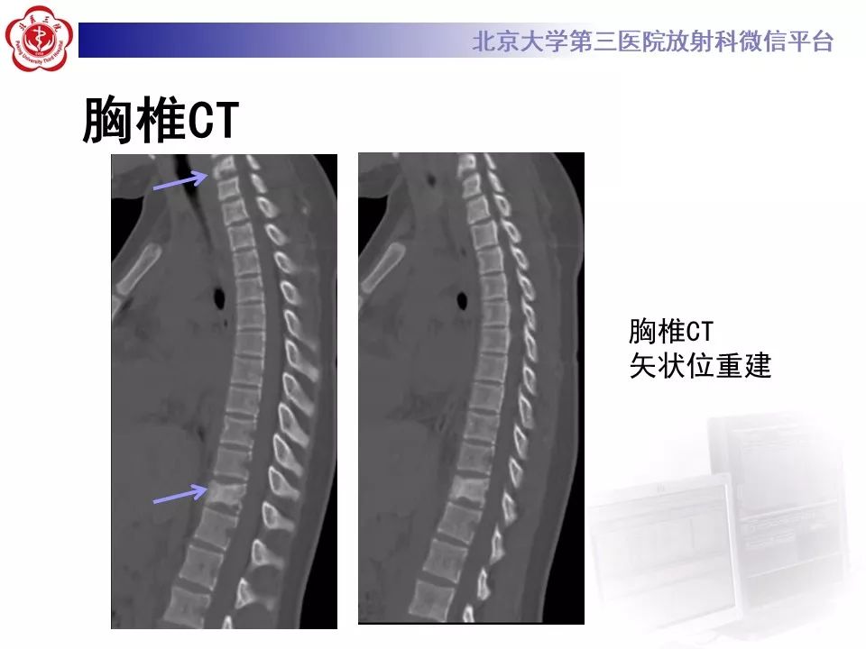 【病例】慢性复发性多灶性骨髓炎1例X线CT及MR