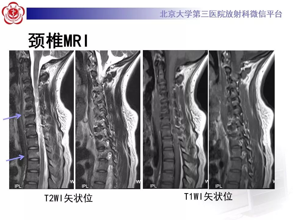 【病例】慢性复发性多灶性骨髓炎1例X线CT及MR