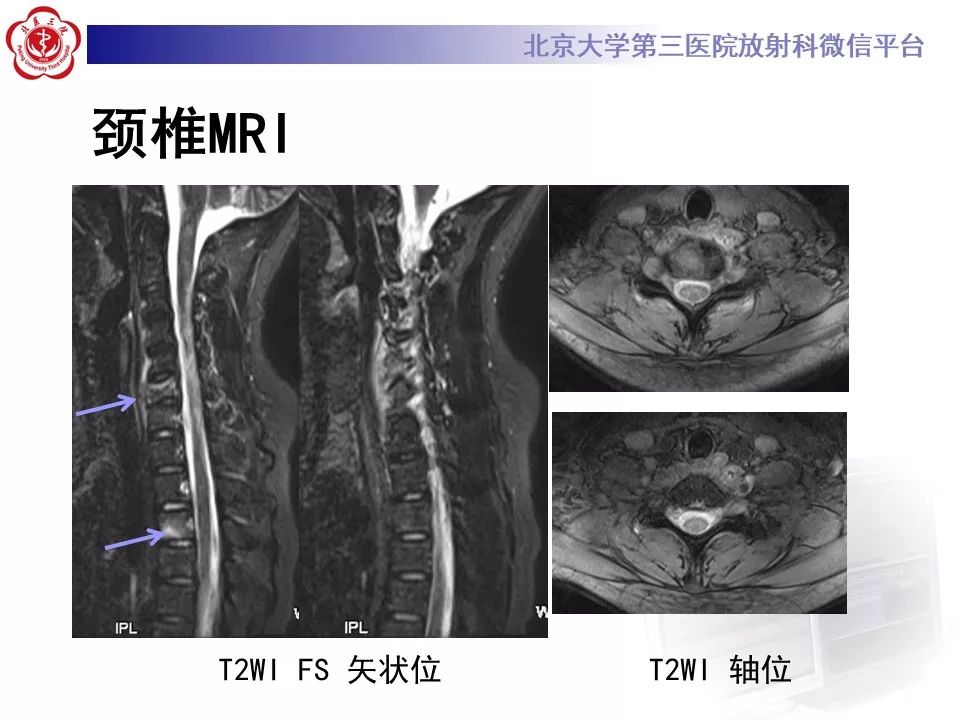 【病例】慢性复发性多灶性骨髓炎1例X线CT及MR