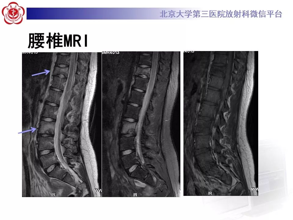 【病例】慢性复发性多灶性骨髓炎1例X线CT及MR