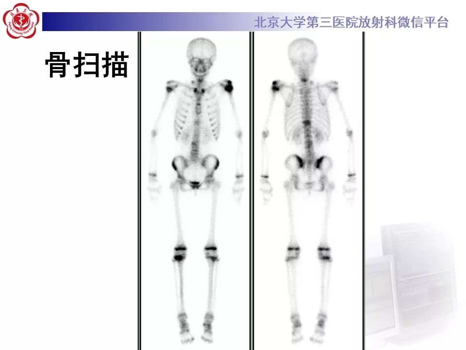 【病例】慢性复发性多灶性骨髓炎1例X线CT及MR
