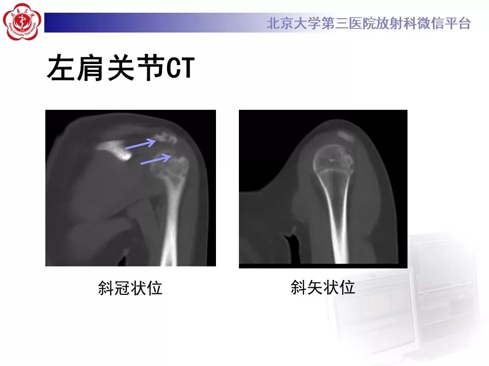 【病例】慢性复发性多灶性骨髓炎1例X线CT及MR