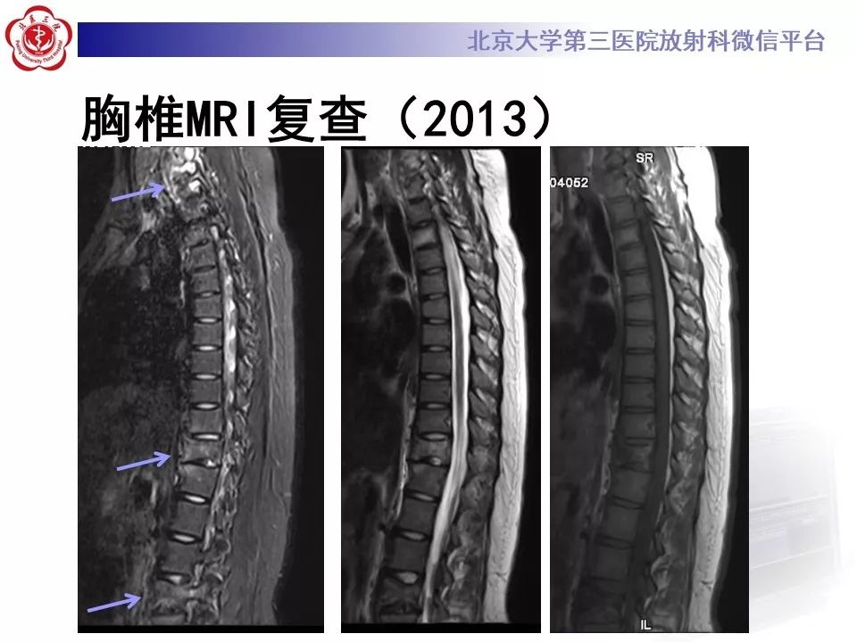 【病例】慢性复发性多灶性骨髓炎1例X线CT及MR