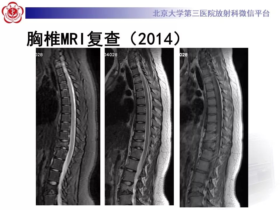 【病例】慢性复发性多灶性骨髓炎1例X线CT及MR