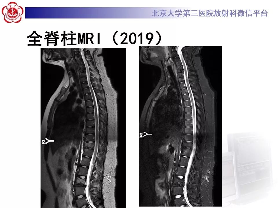 【病例】慢性复发性多灶性骨髓炎1例X线CT及MR