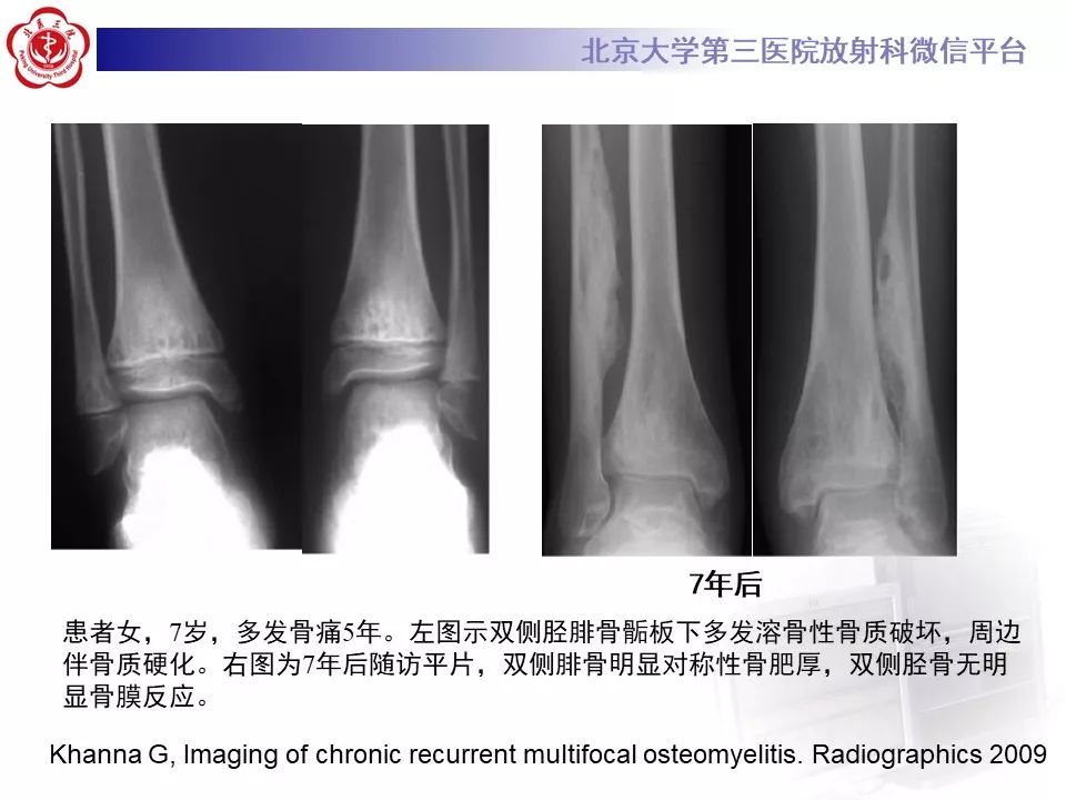 【病例】慢性复发性多灶性骨髓炎1例X线CT及MR