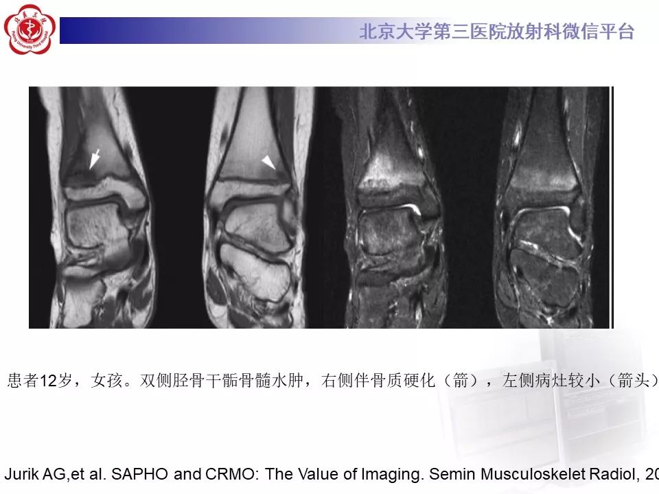 【病例】慢性复发性多灶性骨髓炎1例X线CT及MR