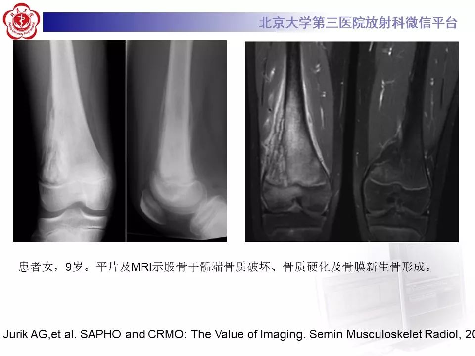 【病例】慢性复发性多灶性骨髓炎1例X线CT及MR