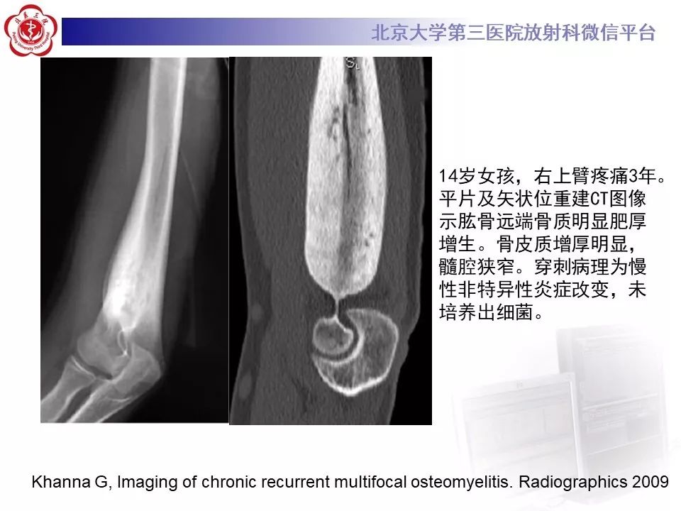 【病例】慢性复发性多灶性骨髓炎1例X线CT及MR