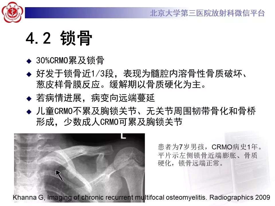 【病例】慢性复发性多灶性骨髓炎1例X线CT及MR