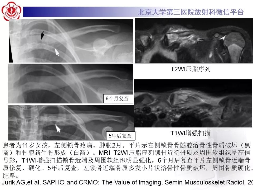 【病例】慢性复发性多灶性骨髓炎1例X线CT及MR