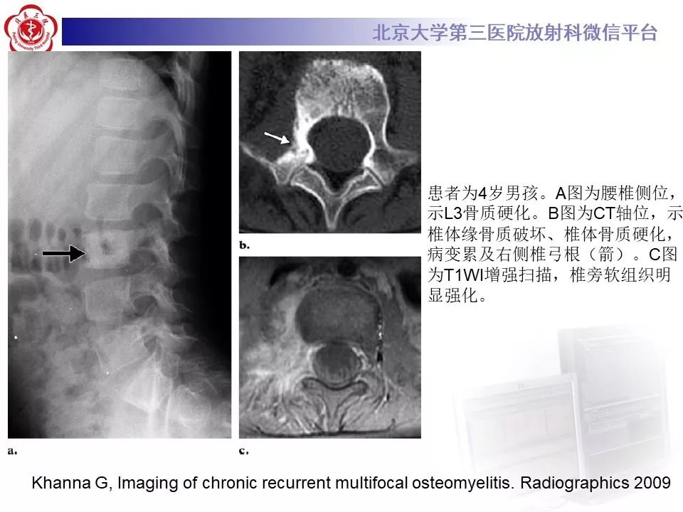 【病例】慢性复发性多灶性骨髓炎1例X线CT及MR