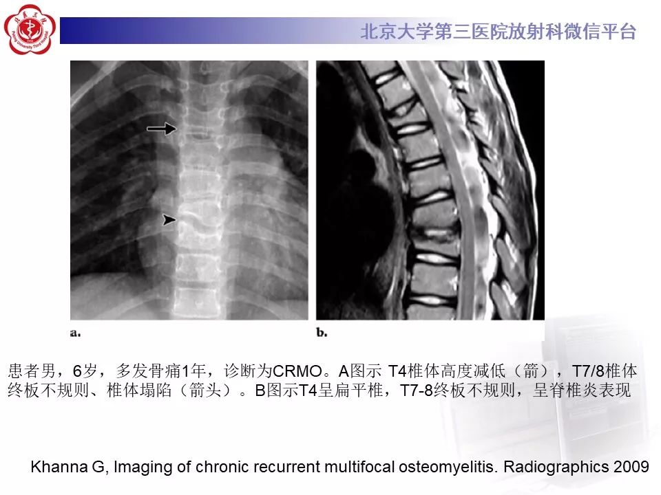 【病例】慢性复发性多灶性骨髓炎1例X线CT及MR