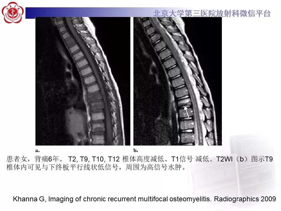【病例】慢性复发性多灶性骨髓炎1例X线CT及MR