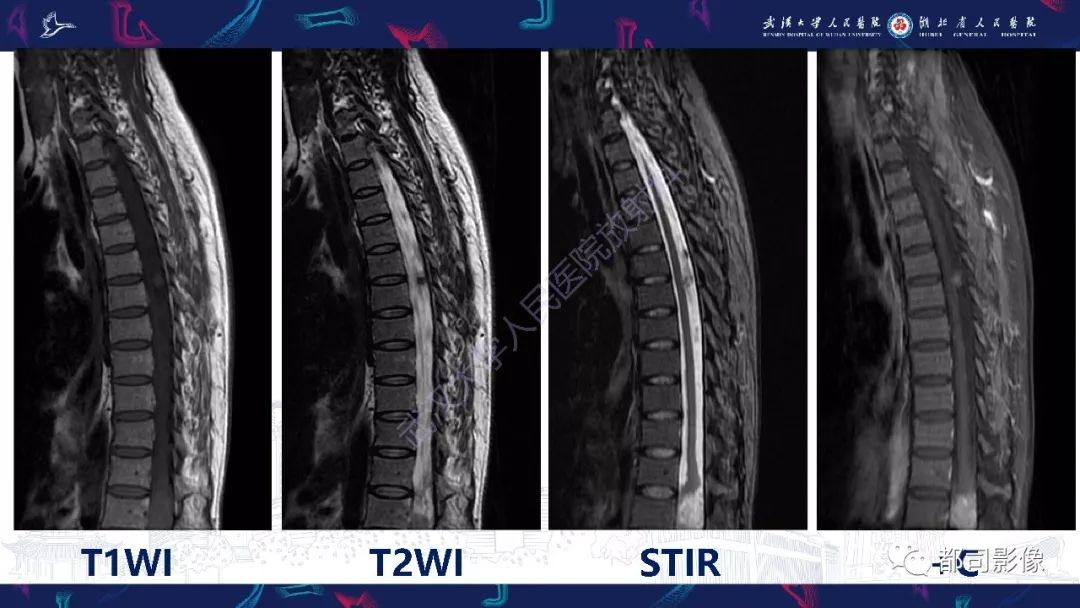 【病例】少见脊膜瘤影像诊断