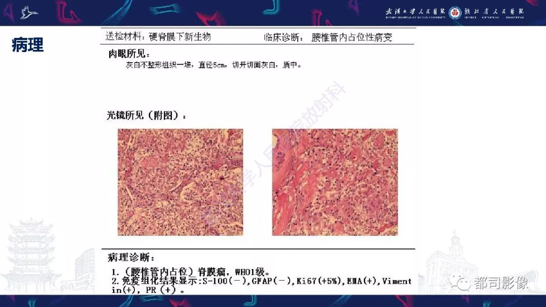 【病例】少见脊膜瘤影像诊断