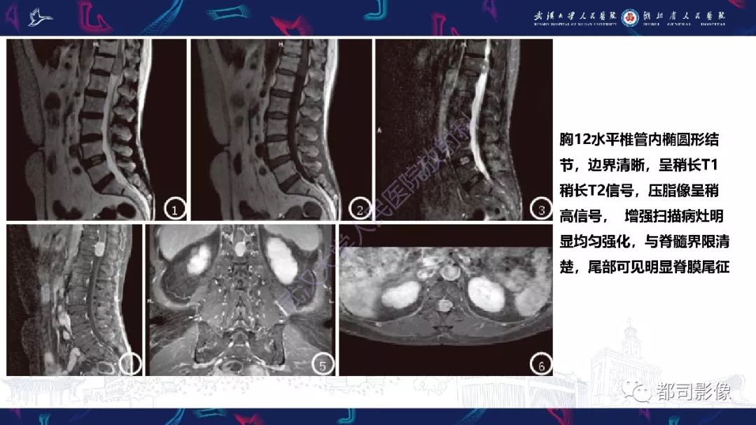 【病例】少见脊膜瘤影像诊断