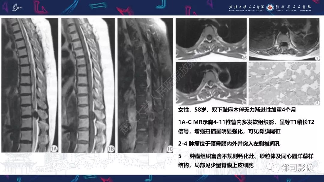 【病例】少见脊膜瘤影像诊断