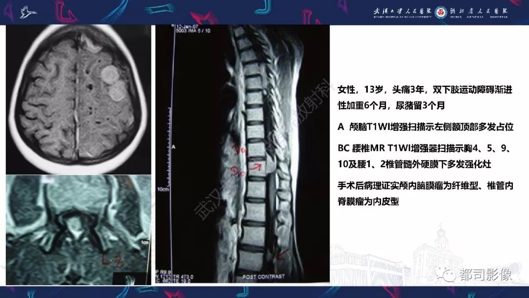 【病例】少见脊膜瘤影像诊断