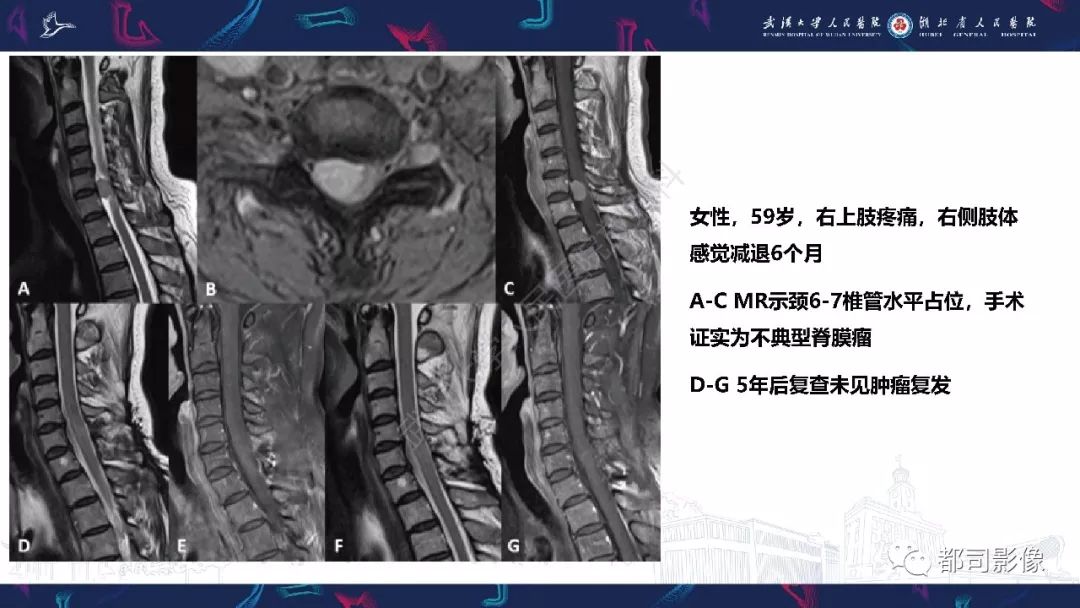 【病例】少见脊膜瘤影像诊断
