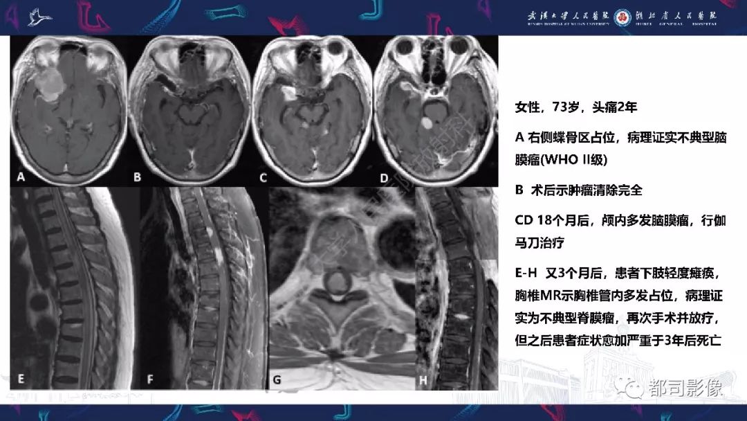 【病例】少见脊膜瘤影像诊断