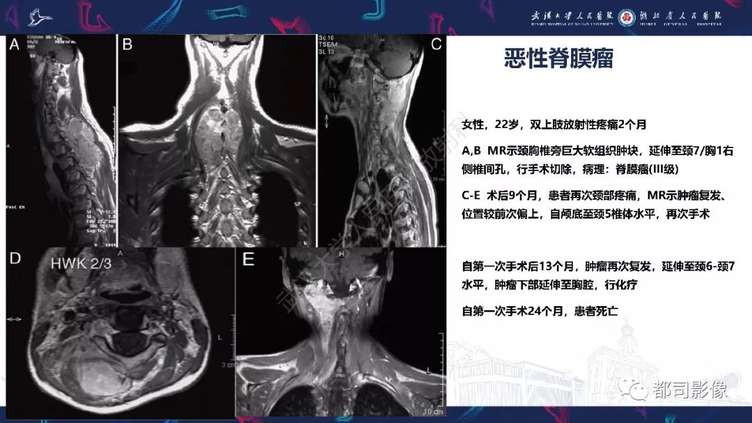 【病例】少见脊膜瘤影像诊断