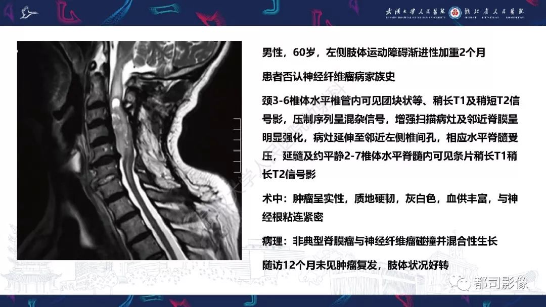 【病例】少见脊膜瘤影像诊断